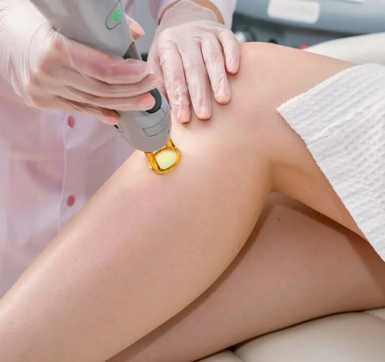 Laser Hair Removal